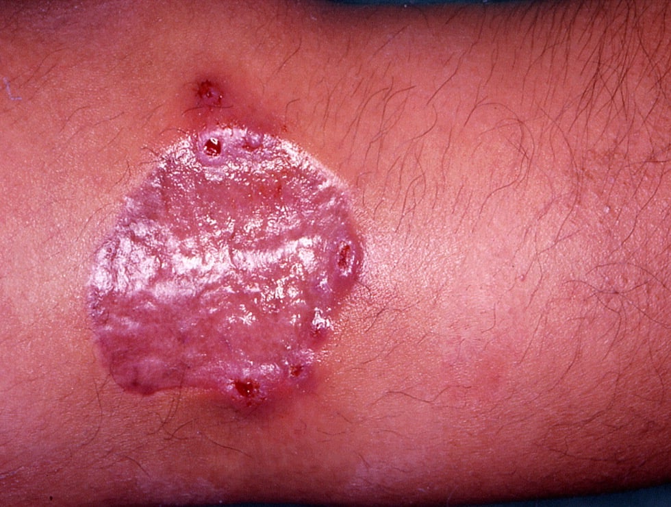 ‘မြေတုပ်ကွေး’ ကြောင့် သေဆုံးနှုန်း မြင့်တက်လာရာ ထိုင်းတွင် သတိပေးချက်များ ထုတ်ပြန်